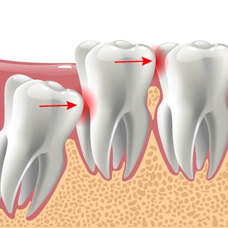 Diagram showing why do wisdom teeth need to be removed in Laguna Niguel  
